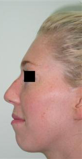 nose surgery
